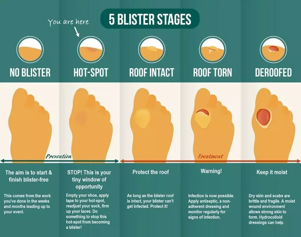 The 5 blister stages help you identify if you need prevention or treatment.