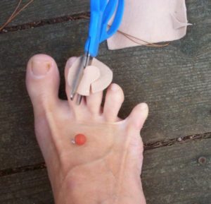 Moleskin patches are key for treating foot blisters.