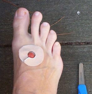 Cut a donut-shaped hole in your moleskin bandage.
